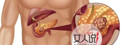 胰腺癌是怎么回事，胰腺癌有哪些早期症状